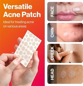 PIMPLE PATCH- HYDROCOLLOID ACNE PATCH FOR FACE ZITS, BLEMISH SPOT TREATMENT - Picture 1 of 7