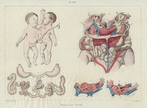 MUTATIONEN. "Monstruosités" Pl. VII. Verbundene Zwillinge 1833 alter antiker Druck - Bild 1 von 1