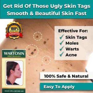 NEW SAFE & FAST SKIN TAG REMOVER LIQUID MOLE WART ACNE PIMPLE PATCH REMOVAL SPOT - Picture 1 of 8