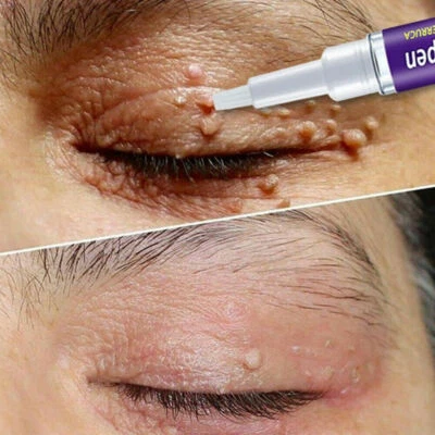 Unisex 3ml 12 Hours Wart Remover Pen Eliminate Foot Corn Warts Skin Tag Remover. - Image 1 of 4