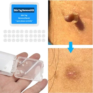 60 Stck. Gummiringe Hautanhängsel Entfernungsbänder Maulwurf Warze Micro Bands Tag Remover Werkzeug - Bild 1 von 12
