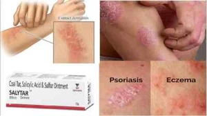 Coal Tar & Salicylic Acid Ointment (15gm) for Psoriasis,Eczema & Other Skin Care - Picture 1 of 2