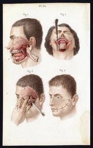 Cabinet curiosité planche affiche A3 anatomie humaine chirurgie n°39 le visage - Imagen 1 de 1