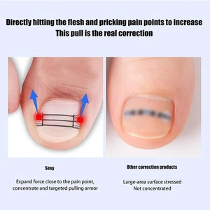 Toenail Fixer Ingrown Toenails Corrector Toenail Straightener Bunion Corrector - Picture 1 of 11