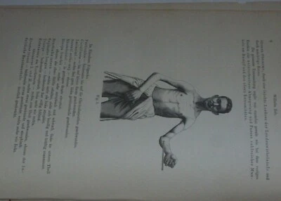 Dystrophia Muscularis Progressivae - Image 1 of 4