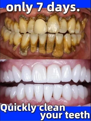 Removedor original cálculo dental clareador dentes boca odor mau hálito prevenir - Imagem 1 de 4