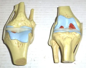 Set of 2 GPI Anatomicals Stages of Osteoarthritis Knee Joint Models (2004) READ - Picture 1 of 10