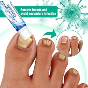 Nail Treatment Fungus Anti Fungal Toe Removal Care Infection Ointment Solution* - Picture 1 of 10