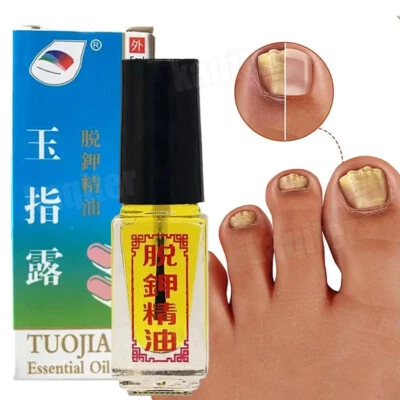 Tratamientos de hongos en las uñas Cuidado de los pies Uñas de los pies Gel Eliminación Onicomicosis Efecto 3 días Foto 1 de 4