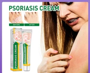 Psoriasis Cream Eczema Ointment Skin Treatment Scalp Hand Foot - Picture 1 of 6