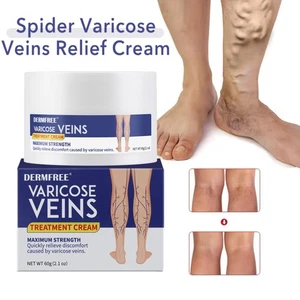 Varicose Veins Treatment Cream Vasculitis Phlebitis Spider Veins Relief Gel 60g - Picture 1 of 27