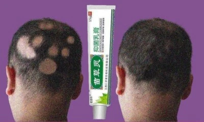 Alopecia areata, alopecia areata, shaving, hair growth, dense hair, - Image 1 of 3