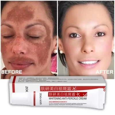 Powerful Spot-removing Whiten Cream Pigmentation Melasma Dark Spots - Image 1 of 4