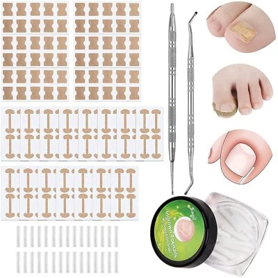 152 Stücke Eingewachsene Zehennägel Set Zehennagel Korrektur Patch, Zehennagel K - Bild 1 von 4