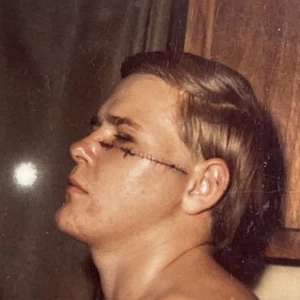 Vintage Foto Verletzung bandagierter Mann Stiche unter Auge Schnappschuss Americana - Y1 - Bild 1 von 8