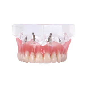 Impianto dentale Denti Modello Demo Restauro Overdenture con 4 Impianti Superiore - Foto 1 di 7