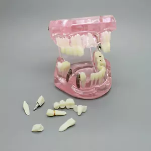Modelo dental Enseñar Estudio Implante oral Restauración Puente Patología Rosa - Imagen 1 de 4