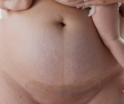 Silicone Gel Scar Strips Washable & Reusable - Bare Mum Foto 1 de 4