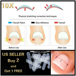 10Pcs Ingrown Toe Foot Nail Correction Sticker Pedicure Tool Toenail Corrector - Picture 1 of 14