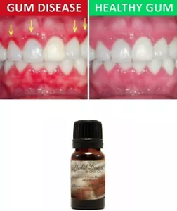 GINGIVITIS TREATMENT OIL | Mouthwash Bad Breath Gum Disease Receding Gums - Picture 1 of 6