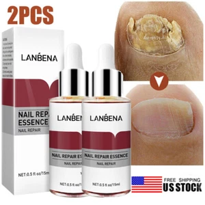 2-Pack Anti Fungal Nail Treatment Nail Finger Toe Fungus Onychomycosis Remover - Picture 1 of 12