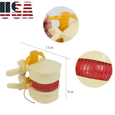 Carejoy 1:1.5  Spine Lumbar Disc Herniation Demonstration Model Medical Tool US