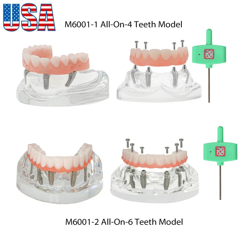 US All-on-4/6 Screws Restoration Overdenture Dental Implant Model Upper Jaw - Image 1 of 4