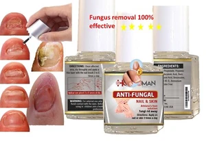 ANTI FUNGAL Support EXTRA STRENGTH FUNGUS ATHLETES FOOT FUNGU NAIL TOENAIL 1oz - Picture 1 of 5