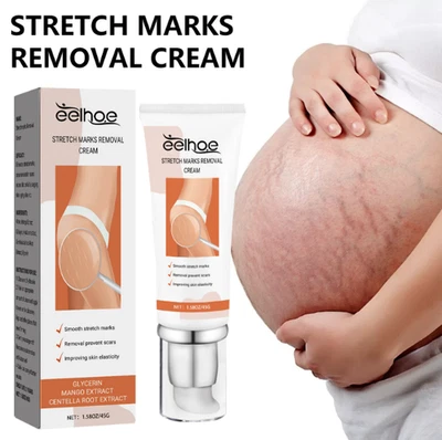 Stretch Marks Removal Cream – Pregnancy Belly Repair & Scar/Spot Remover - Image 1 of 4