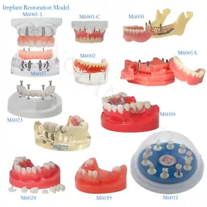 Modelo de implante dental, mandíbula superior inferior, dentaduras RPD, tipos de restauración de sobredentaduras - Imagen 1 de 154