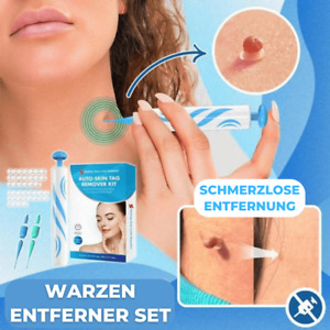 2in1 Warzenentferner Kit Warze Papillome Skin Tag Remover Schmerzloser Entferner