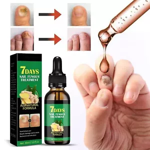 7 Days Nail Fungus Treatment All Natural Formula Gingers Nail Toenail Care 30ml - Picture 1 of 12
