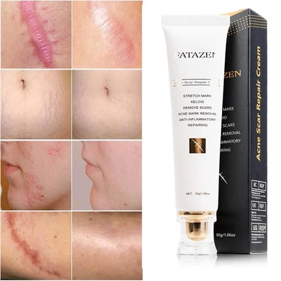 For Surgical Burns C-Section Scar Stretch Marks Keloids Medical-grade Scar Cream - Image 1 of 4