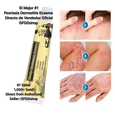 Crema Para Dermatitis Eczema Psoriasis Para Comezon Picazon Ronchas En La Piel - Image 1 of 4