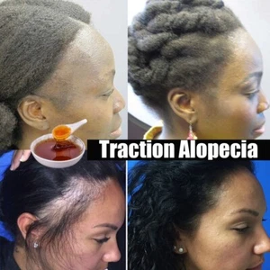 Fast Hair Growth Oil Africa Traction Alopica Serum Promotes Hair Growth 30ML - Picture 1 of 7