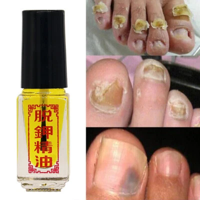 3 Giorni Effetto Realmente Funzionante Trattamento Unghie Rimozione Onicomicosi Paronichia Toe - Immagine 1 di 4