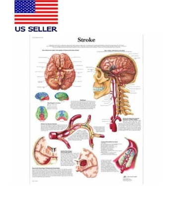 Stroke Poster/ Stroke Chart/ Anatomical Reference/ 16”x 24” W Silk Fabric - Image 1 of 2