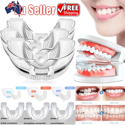 Dental Alignment Straightener Teeth Retainer Orthodontic Braces Mouth Guard QT - image 1 of 4