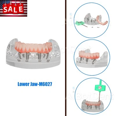 Modelo de restauración de implantes dentales de EE. UU. M6027 mandíbula inferior, 4 tornillos, puente de núcleo de poste Foto 1 de 4