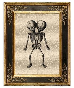 Siamese Twins Skeleton Art Print on Vintage Book Page Home Office Decor Gifts - Picture 1 of 3