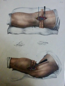 1850 Chirurgie Ligature de l'artère poplitée 1 LITHOGRAPHIE - Imagen 1 de 3