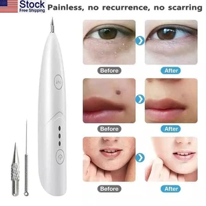 3 Geschwindigkeiten Laser Plasma Stift Anti-Aging Maulwurf Sommersprossen Flecken Entfernung Stift USA Versand - Bild 1 von 9