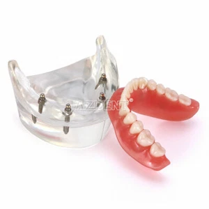 Impianto dentale Denti Modello Demo Restauro Overdenture con 4 Impianti Inferiori - Foto 1 di 12