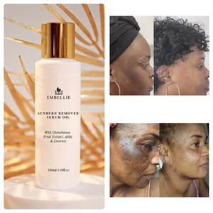 Sunburn Remover Serum Oil, Dark Mark Fade Serum - Picture 1 of 5