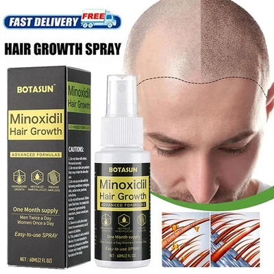 Extra Starke MINOXIDIL 5% Haarwachstum Behandlung Spray Serum FÜR Männer 60ml - Bild 1 von 4