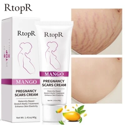 Pregnancy Scar, Spots Acne Scar, Stretch Marks Removal Cream Clarifying skin 40g - Image 1 of 4