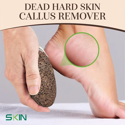 Großer Bimsstein natürliche Fußpflege Schrubber abgestorbene harte Haut Hornhautentferner Werkzeug - Bild 1 von 4