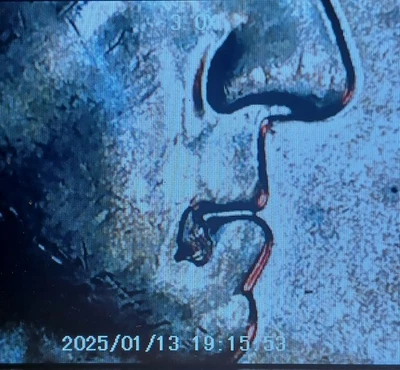 2022 P MAYA ANGELOU Drooling George Error Quarter, Die Chip Errors - Image 1 of 4