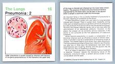 Pneumonia : 2 #16 Lungs Home Medical Guide 1975-8 Hamlyn Card