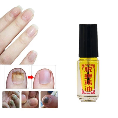 Aceite esencial antiinfección eliminación de hongos efecto 3 días tratamiento de uñas fúngicas 5 ml Foto 1 de 4